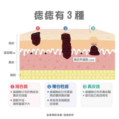 雞雞痣很多|痣變大、痣多或長毛會變皮膚癌？認識痣的形成與原因